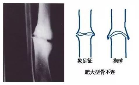 一般骨折多久可以走路？骨折不愈合了再难行走，还好能治？